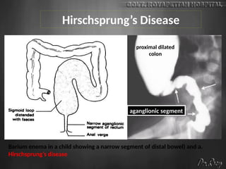 Hirschsprung’s Disease
colon
Barium enema in a child showing a narrow segment of distal bowel) and a.
Hirschsprung’s disease
aganglionic segment
proximal dilated
colon
 
