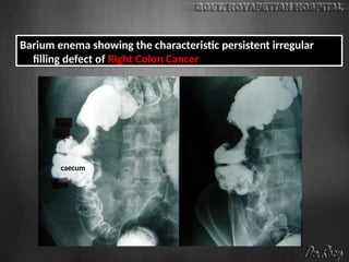 Barium enema showing the characteristic persistent irregular
filling defect of Right Colon Cancer
caecum
 