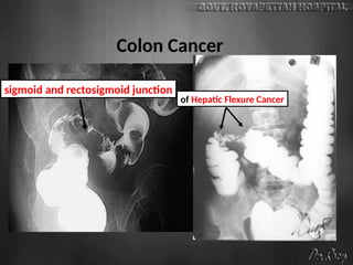 Colon Cancer
of Hepatic Flexure Cancer
sigmoid and rectosigmoid junction
 