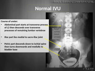Normal IVU
Course of ureter:
• Abdominal part starts at transverse process
of L2 then descends over transverse
processes of remaining lumbar vertebrae
• Iliac part lies medial to sacro-iliac joint
• Pelvic part descends down to ischial spine
then turns downwards and medially to
bladder base
 