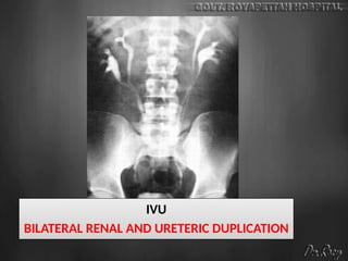 IVU
BILATERAL RENAL AND URETERIC DUPLICATION
 