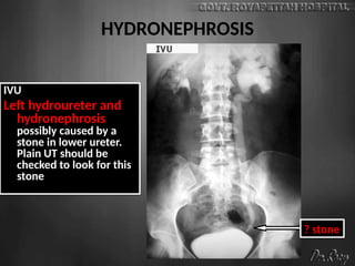 HYDRONEPHROSIS
IVU
Left hydroureter and
hydronephrosis
possibly caused by a
stone in lower ureter.
Plain UT should be
checked to look for this
stone
? stone
 