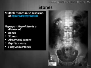 Stones
Multiple stones raise suspicion
of hyperparathyroidism
Hyperparathyroidism is a
disease of
• Bones
• Stones
• Abdominal groans
• Psychic moans
• Fatigue overtones
 