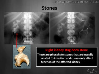 Stones
Right kidney stag-horn stone
These are phosphate stones that are usually
related to infection and commonly affect
function of the affected kidney
Plain UT IVU
 