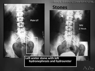 Stones
Plain UT
IVU
Left ureter stone with left
hydronephrosis and hydroureter
 