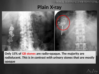 Plain X-ray
Only 15% of GB stones are radio-opaque. The majority are
radiolucent. This is in contrast with urinary stones that are mostly
opaque
 