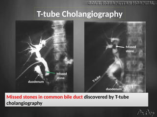 T-tube Cholangiography
duodenum
duodenum
Missed
stone
Missed
stone
T-tube
Missed stones in common bile duct discovered by T-tube
cholangiography
 