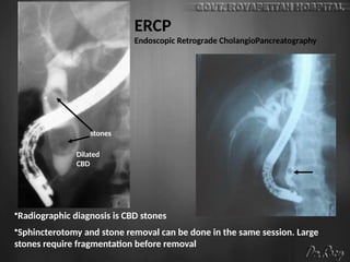 ERCP
Endoscopic Retrograde CholangioPancreatography
•Radiographic diagnosis is CBD stones
•Sphincterotomy and stone removal can be done in the same session. Large
stones require fragmentation before removal
Dilated
CBD
stones
 
