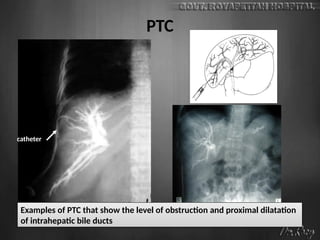 PTC
catheter
Examples of PTC that show the level of obstruction and proximal dilatation
of intrahepatic bile ducts
 