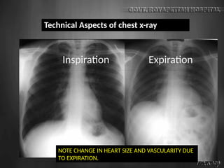 NOTE CHANGE IN HEART SIZE AND VASCULARITY DUE
TO EXPIRATION.
Technical Aspects of chest x-ray
Inspiration Expiration
 