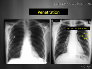 Penetration
DID YOU SEE THE NODULE
 