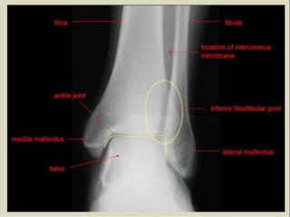 x ray,ct lower limb.pptx lower limb xray | PPTX