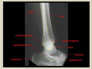 x ray,ct lower limb.pptx lower limb xray | PPTX