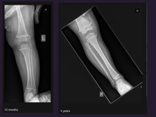 x ray,ct lower limb.pptx lower limb xray | PPTX