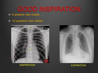 Inspiration Normal Ribs X RAY DETERMINATION AND EVALUATION.pptx