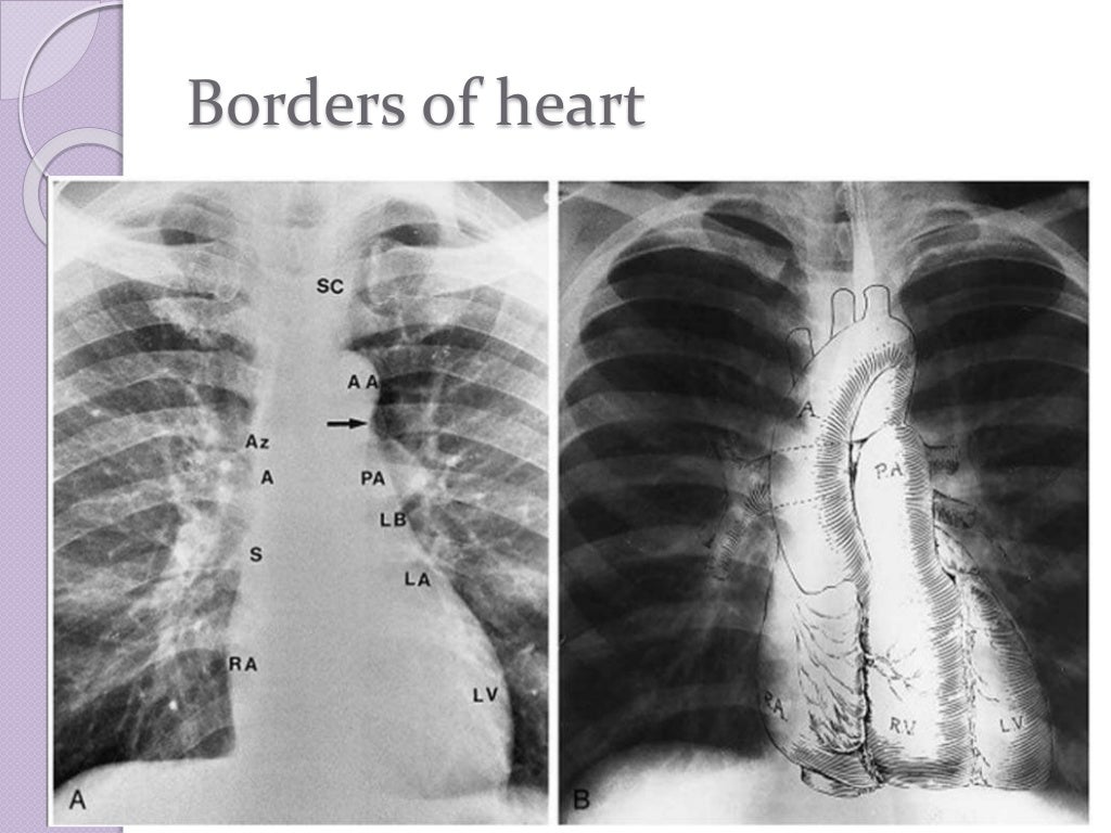 chest radiology in cardiovascular disease