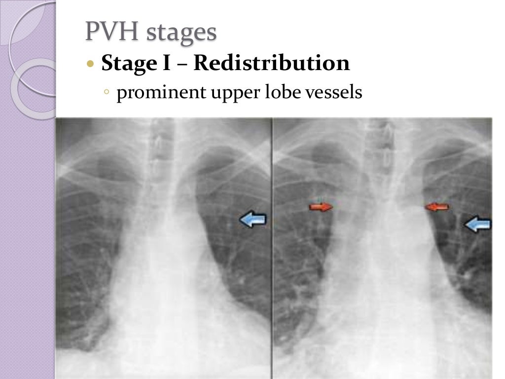 chest radiology in cardiovascular disease