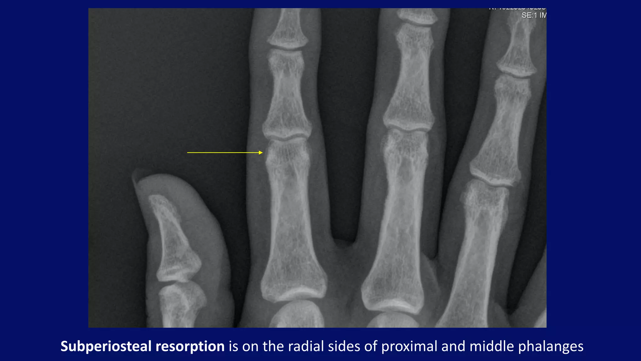 Subperiosteal resorption is on the radial sides of proximal and middle phalanges
 