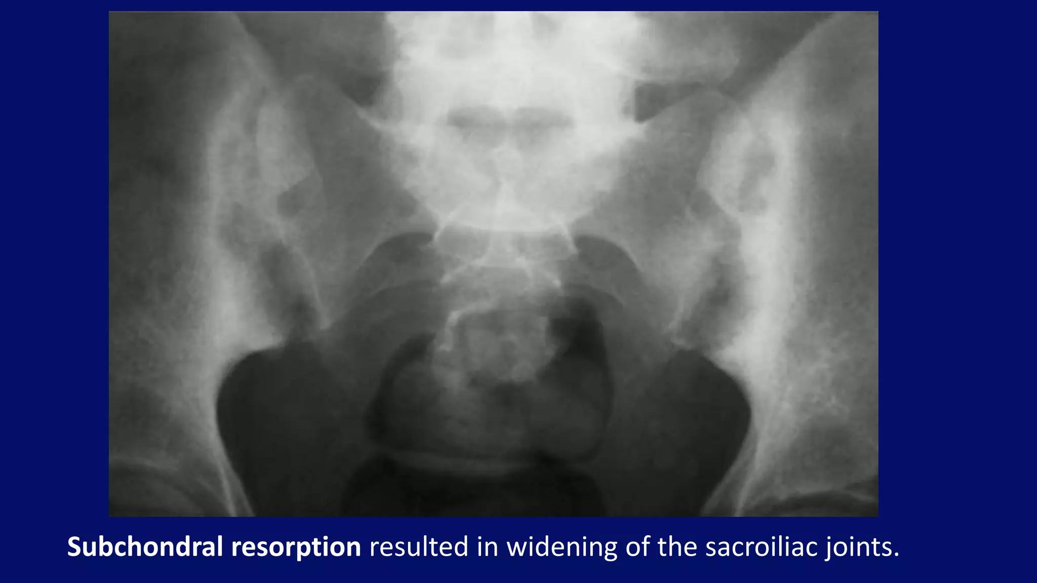 Subchondral resorption resulted in widening of the sacroiliac joints.
 