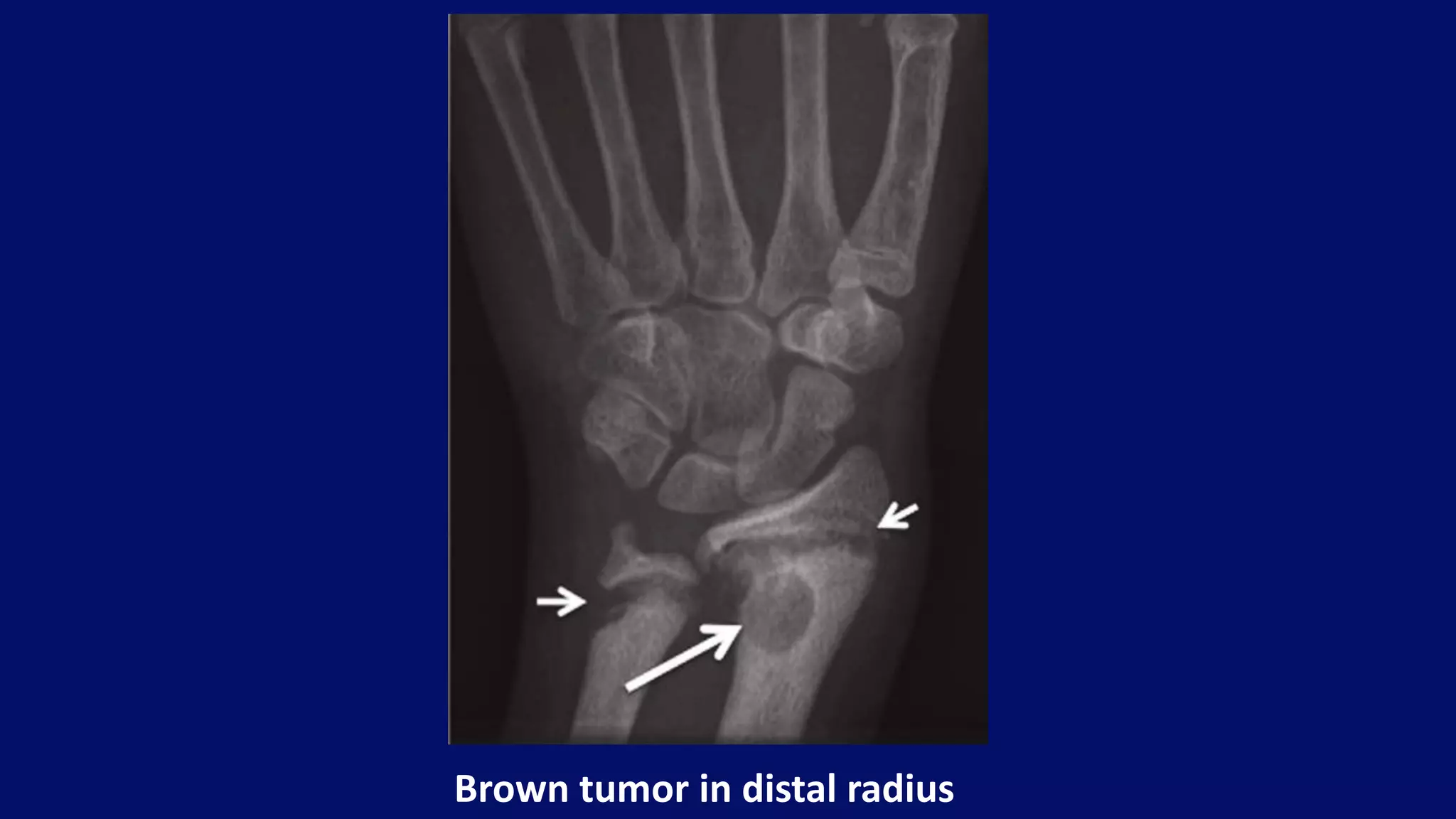 Brown tumor in distal radius
 