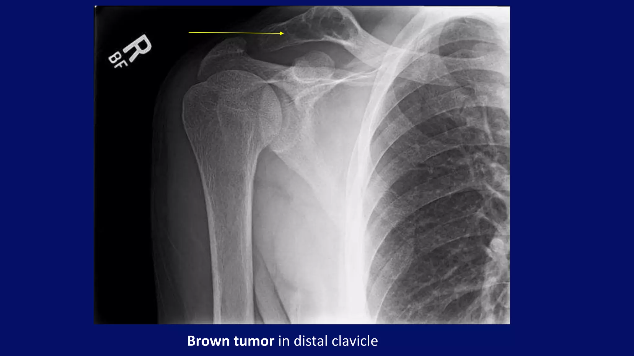 Brown tumor in distal clavicle
 