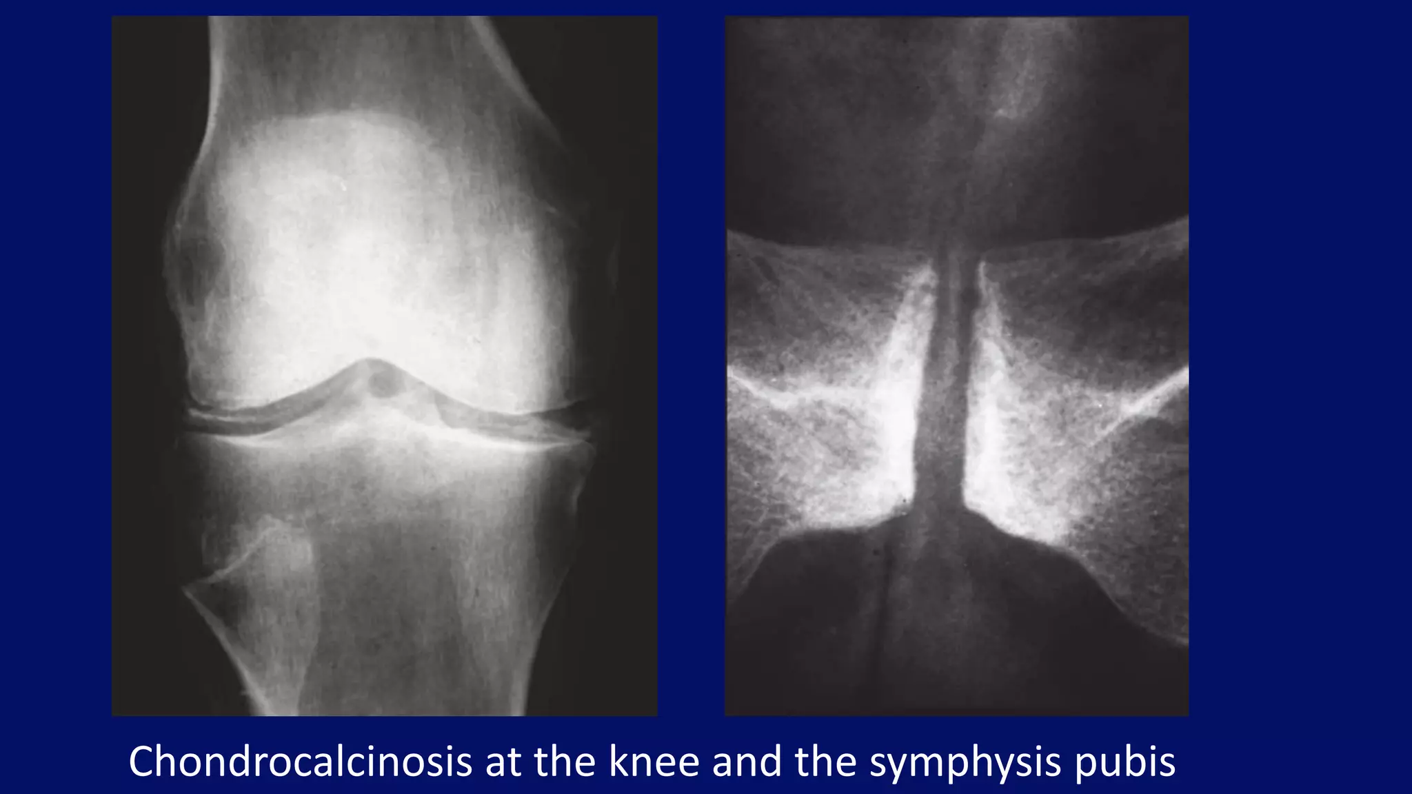 Chondrocalcinosis at the knee and the symphysis pubis
 