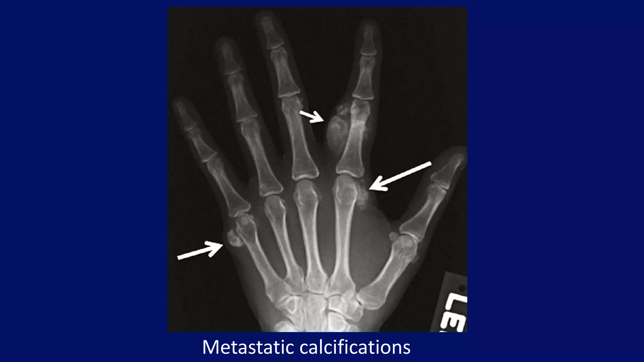 Metastatic calcifications
 