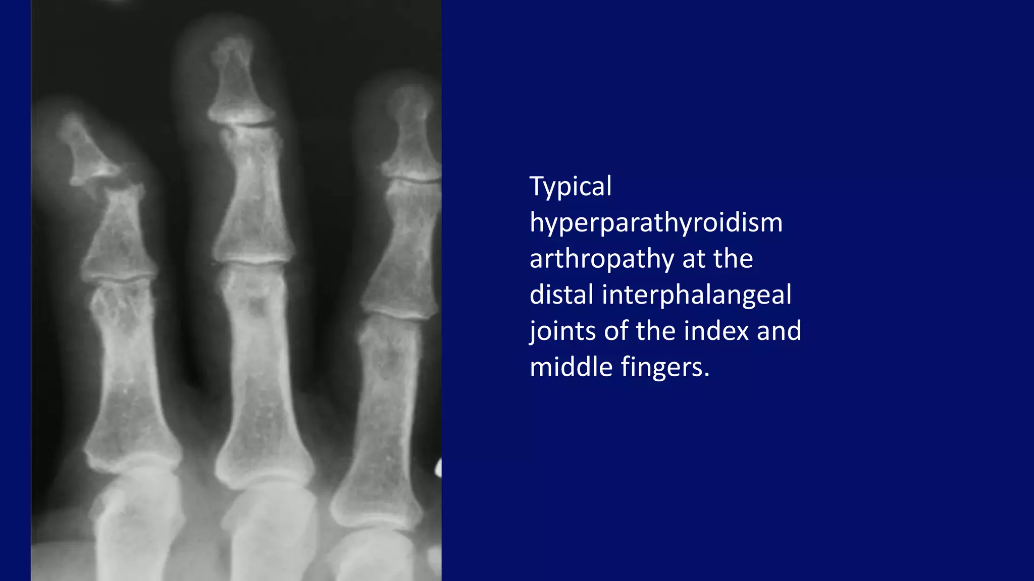 Typical
hyperparathyroidism
arthropathy at the
distal interphalangeal
joints of the index and
middle fingers.
 