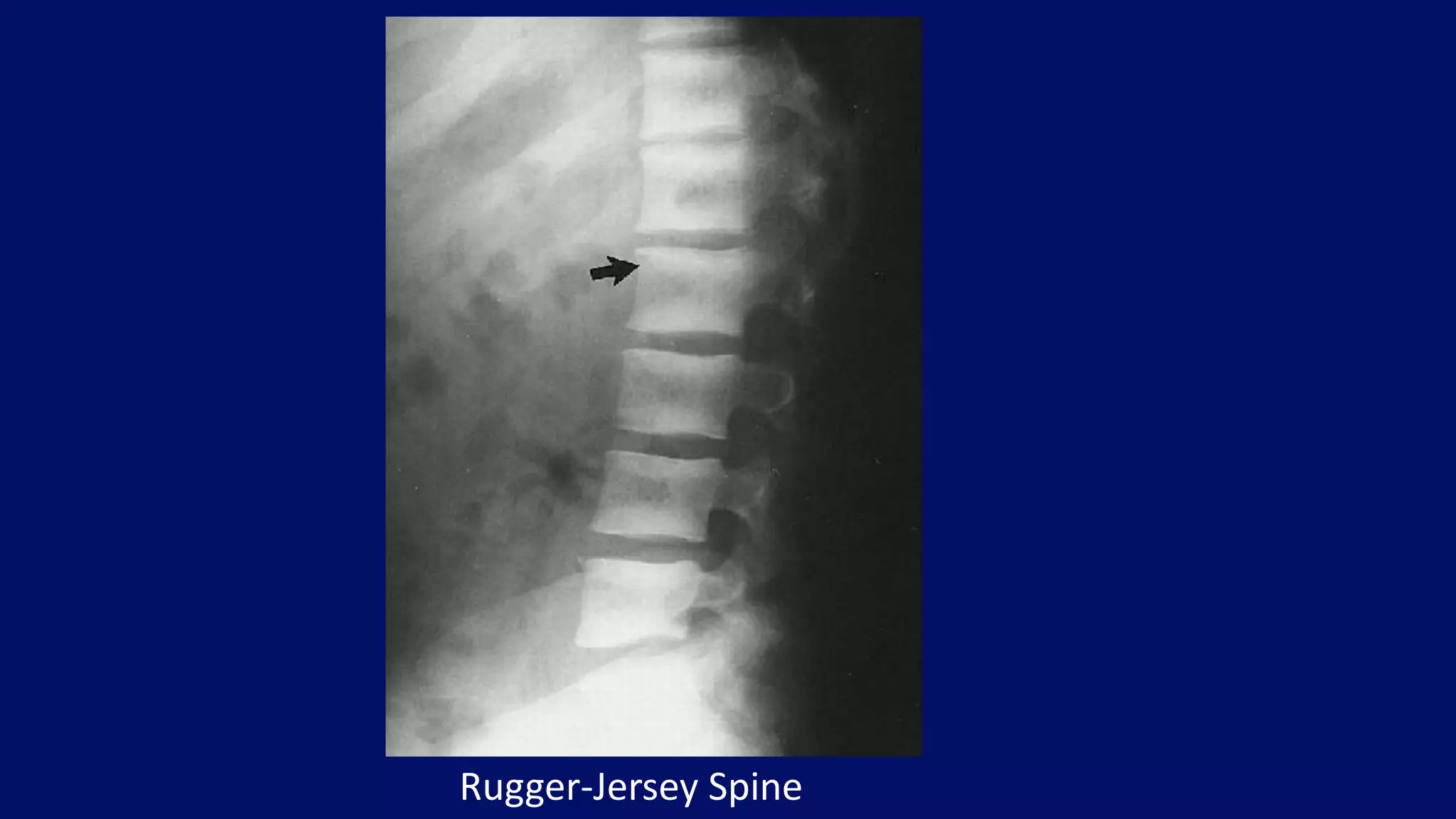 Rugger-Jersey Spine
 