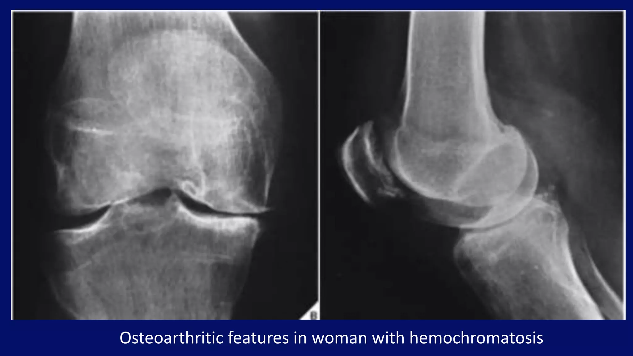 Osteoarthritic features in woman with hemochromatosis
 