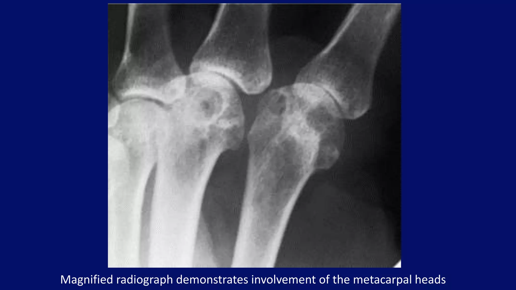 Magnified radiograph demonstrates involvement of the metacarpal heads
 