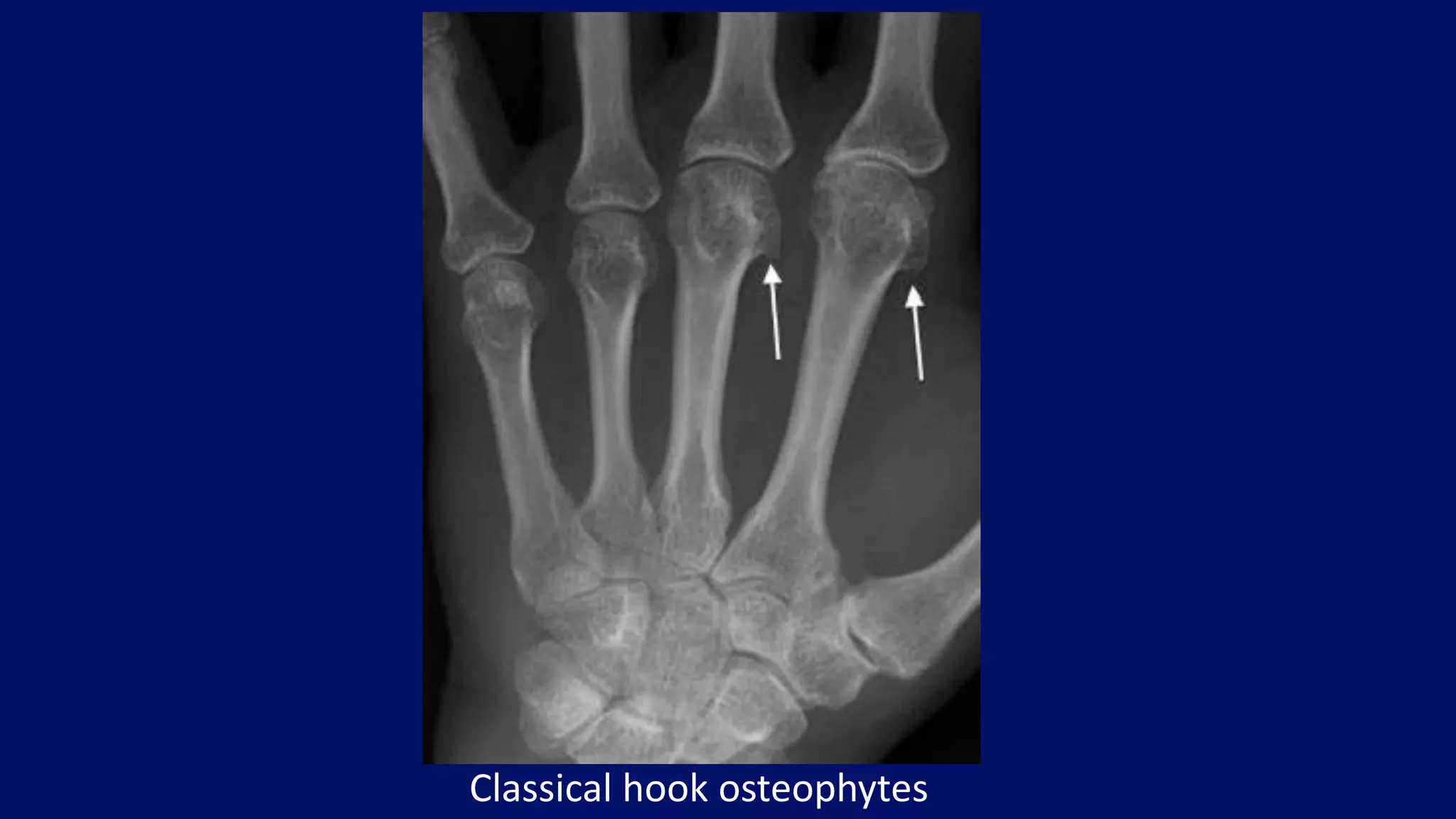 Classical hook osteophytes
 