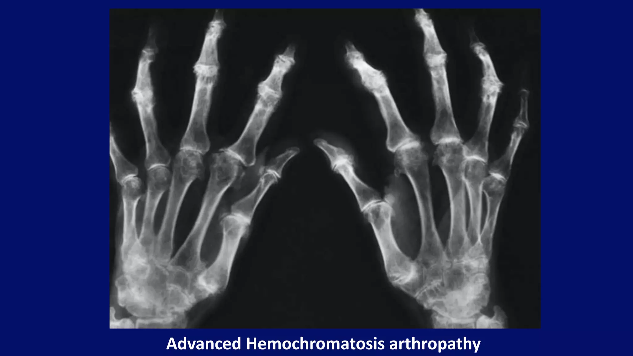 Advanced Hemochromatosis arthropathy
 
