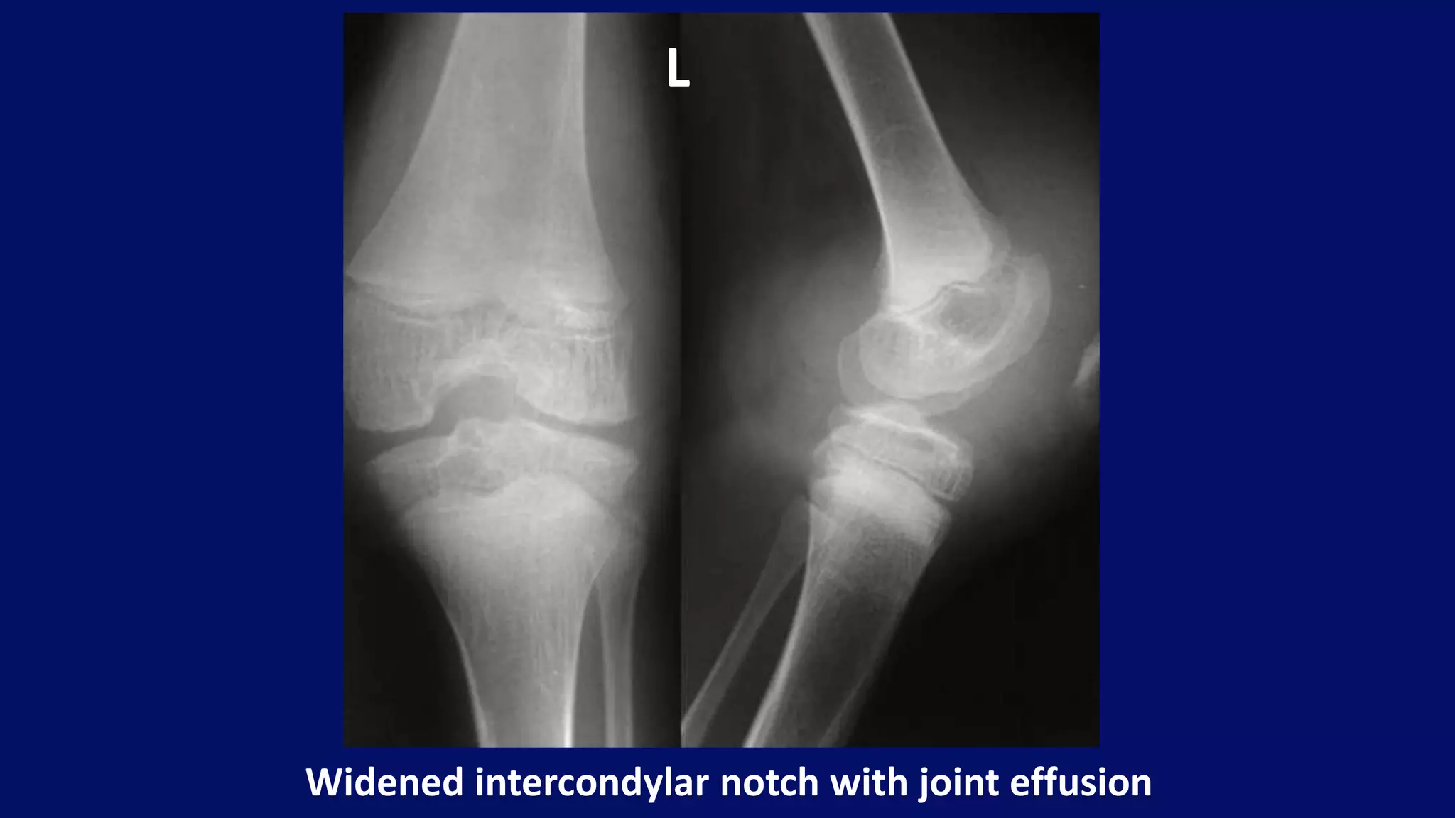 Widened intercondylar notch with joint effusion
L
 