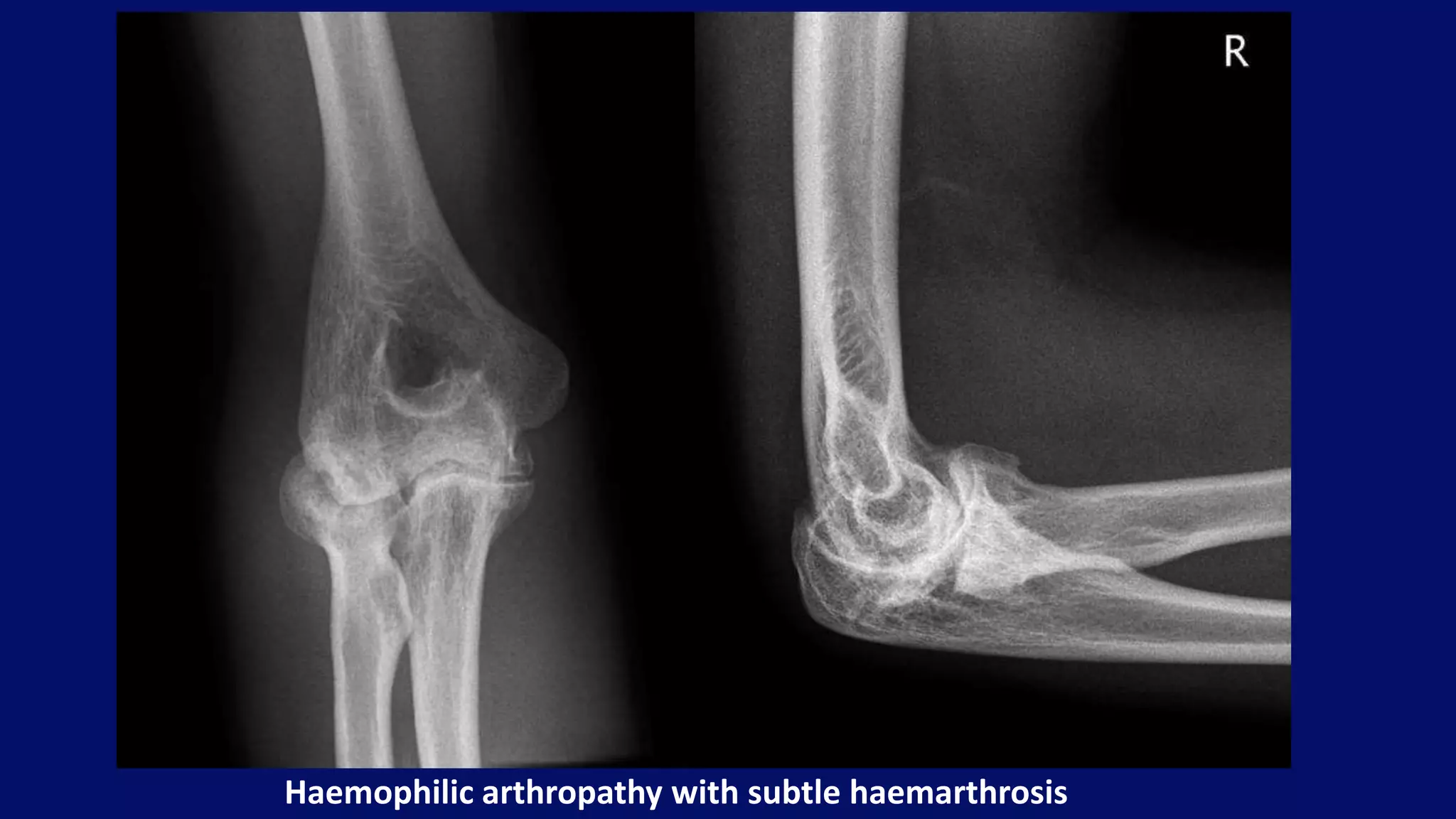 Haemophilic arthropathy with subtle haemarthrosis
 