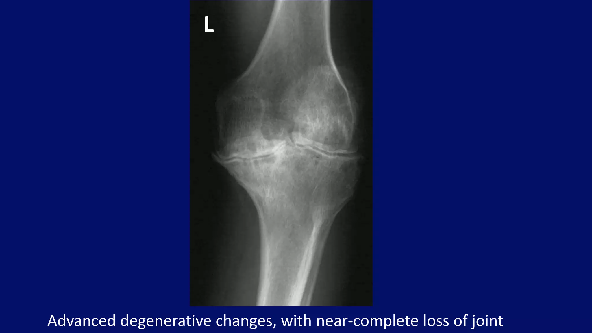 Advanced degenerative changes, with near-complete loss of joint
L
 