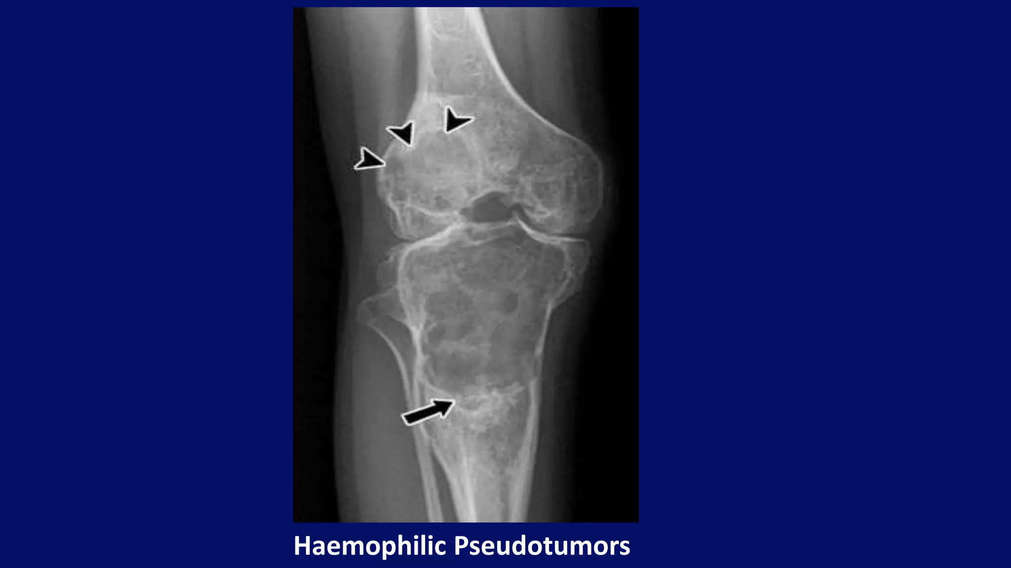 Haemophilic Pseudotumors
 