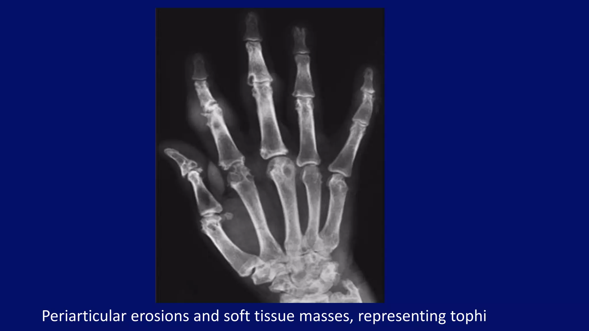Periarticular erosions and soft tissue masses, representing tophi
 