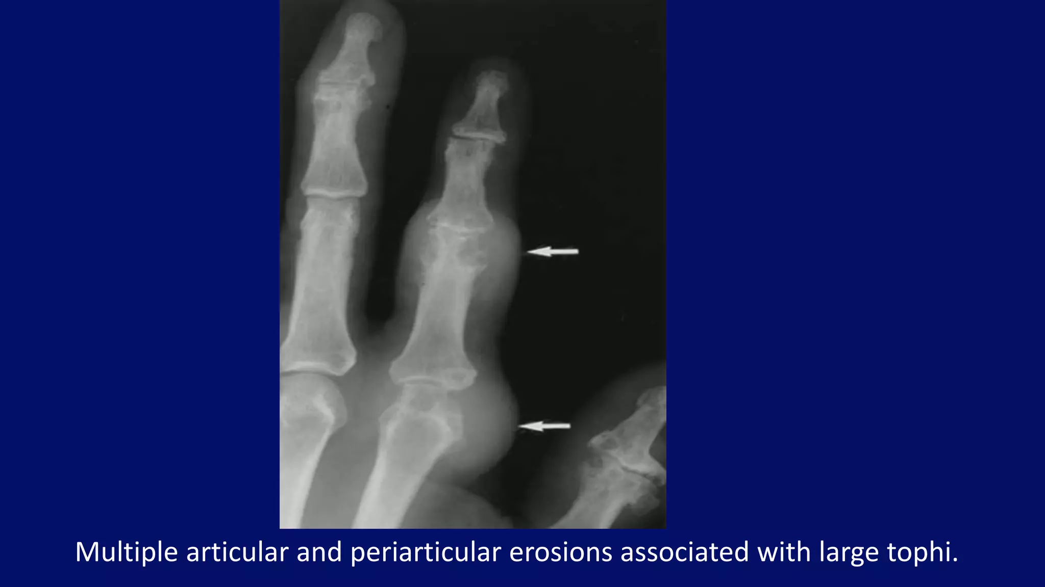 Multiple articular and periarticular erosions associated with large tophi.
 