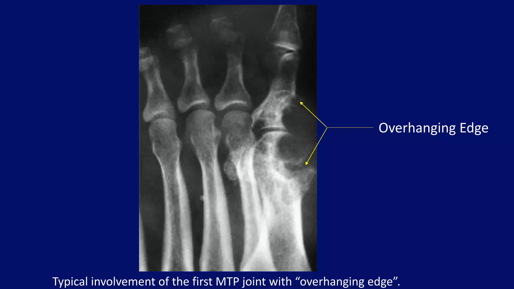 Typical involvement of the first MTP joint with “overhanging edge”.
Overhanging Edge
 