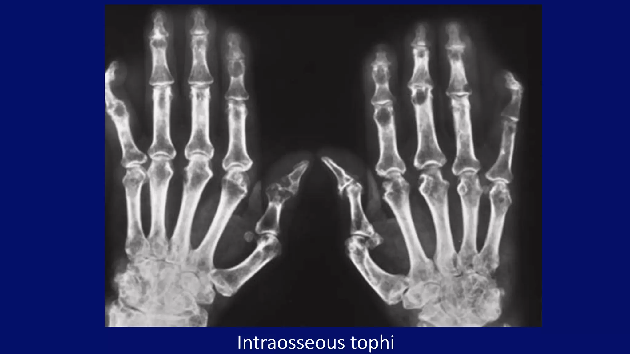 Intraosseous tophi
 
