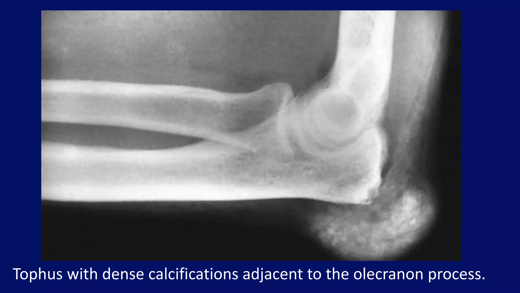 Tophus with dense calcifications adjacent to the olecranon process.
 