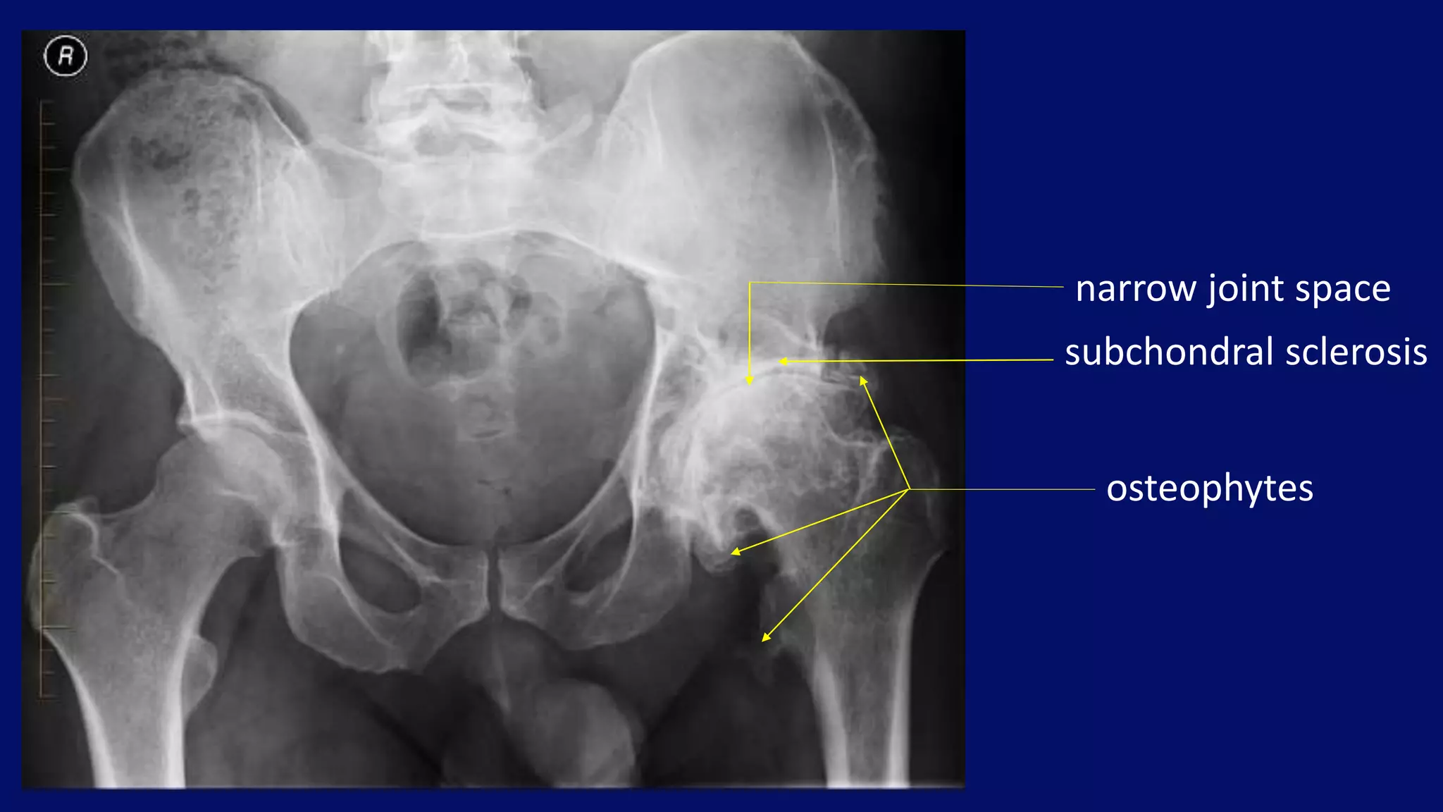 narrow joint space
subchondral sclerosis
osteophytes
 