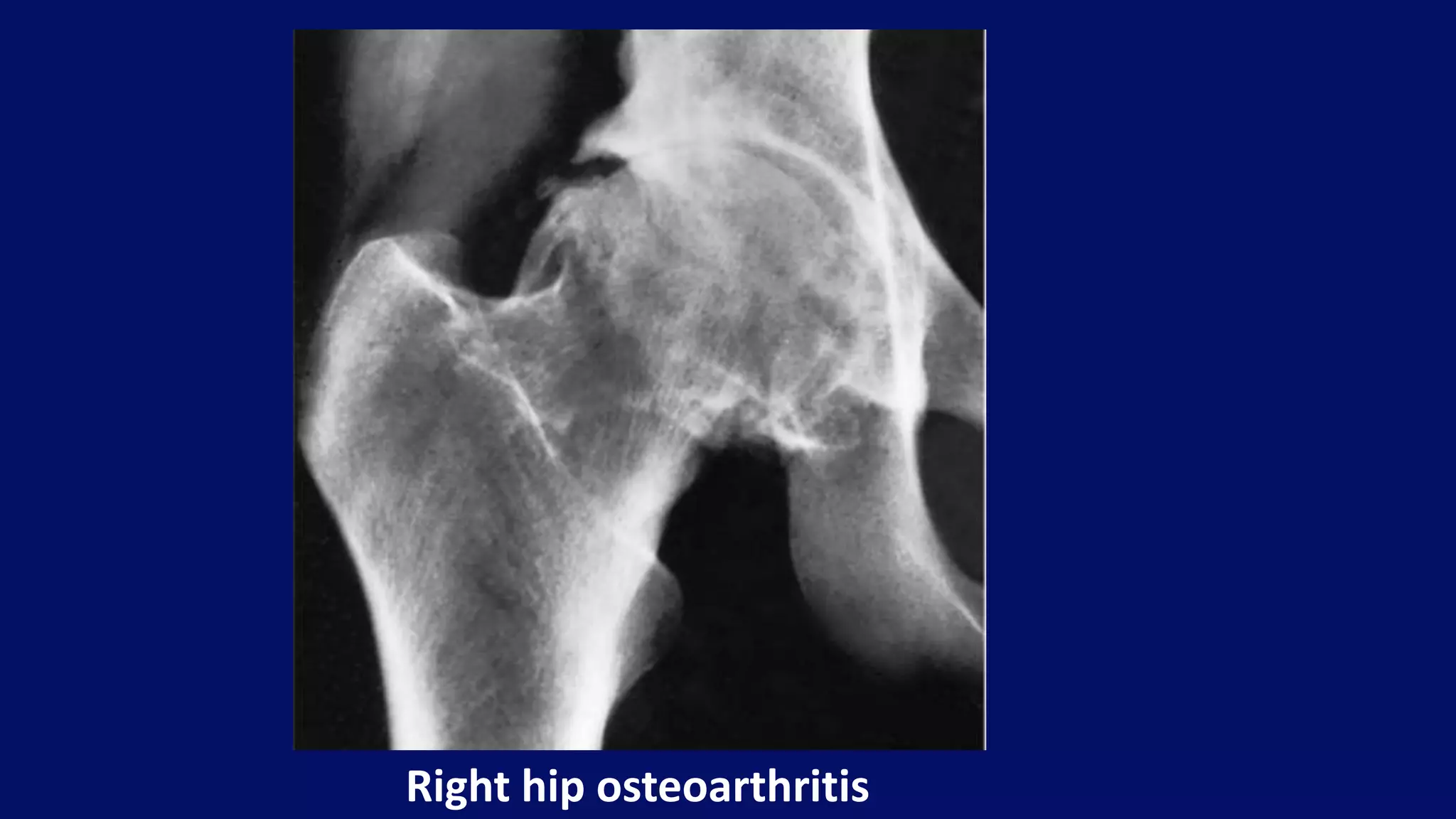 Right hip osteoarthritis
 