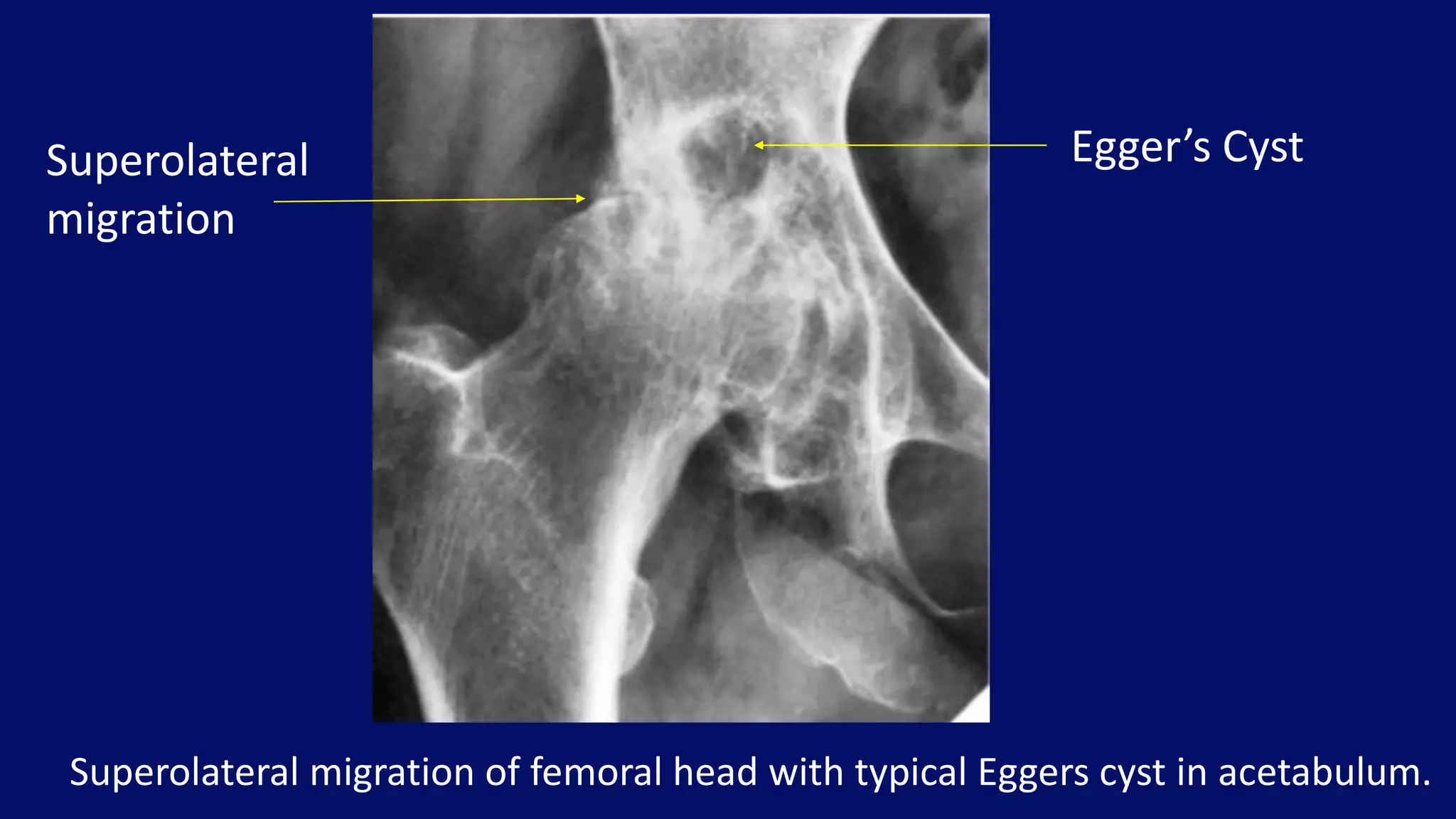 Superolateral migration of femoral head with typical Eggers cyst in acetabulum.
Egger’s CystSuperolateral
migration
 