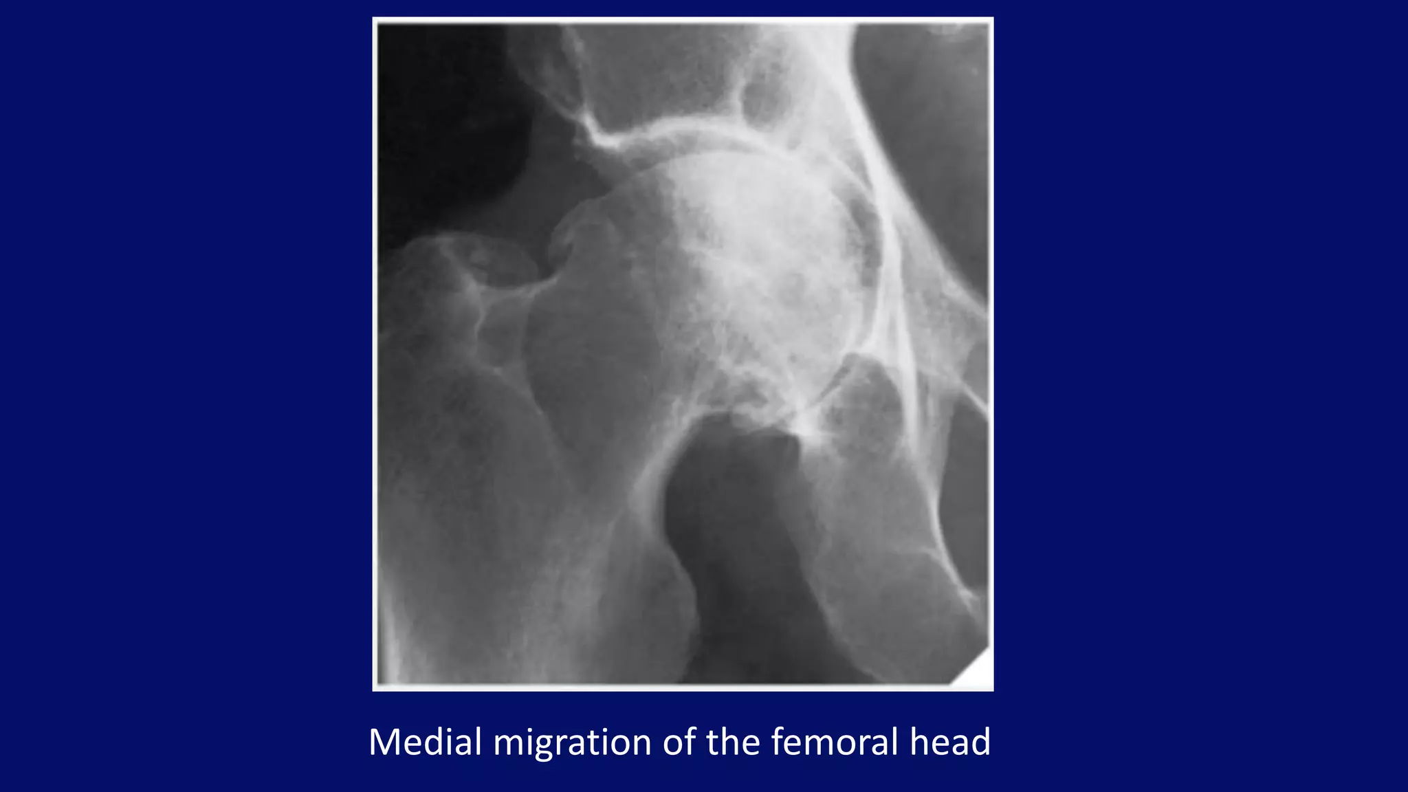 Medial migration of the femoral head
 