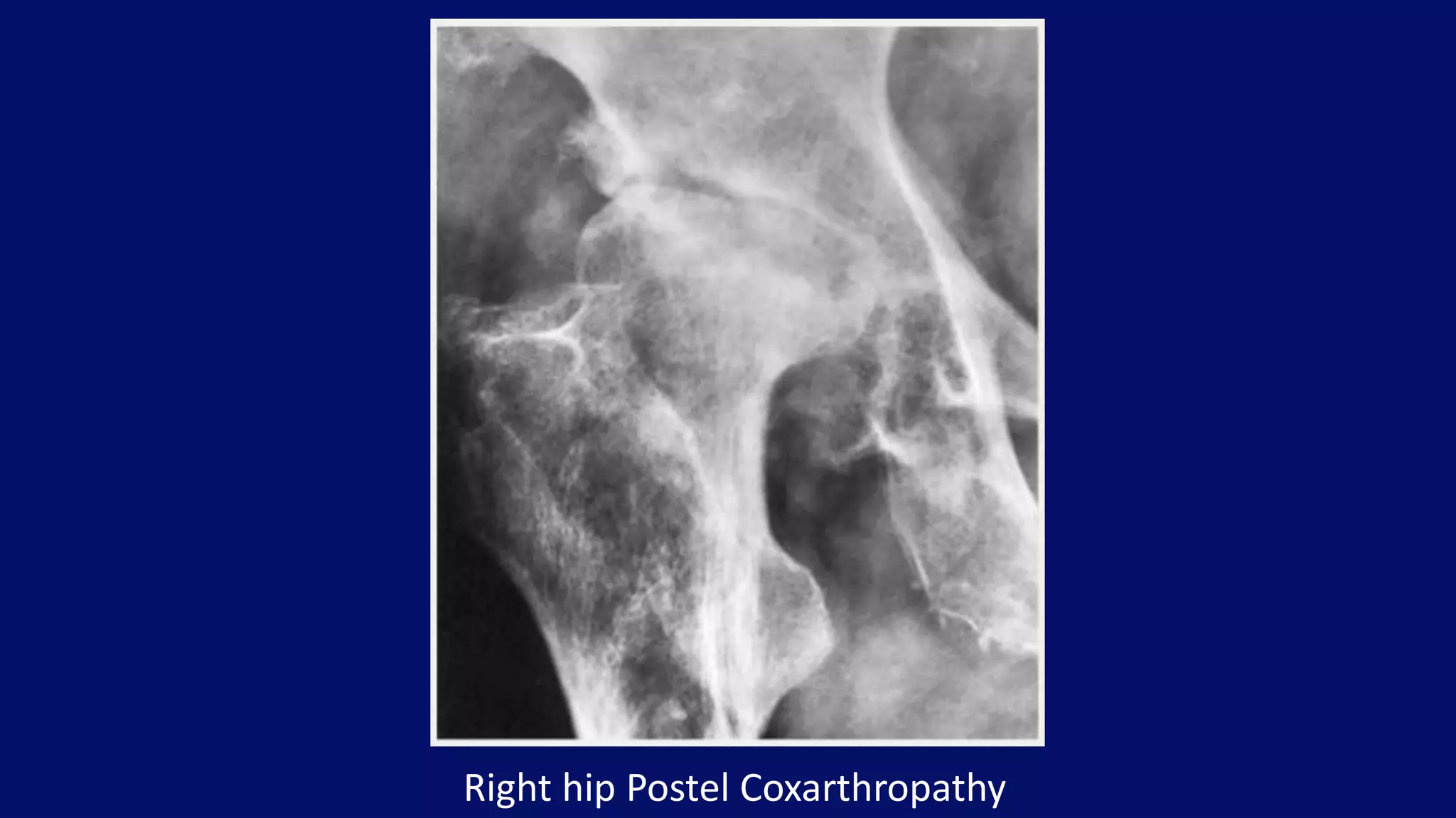Right hip Postel Coxarthropathy
 