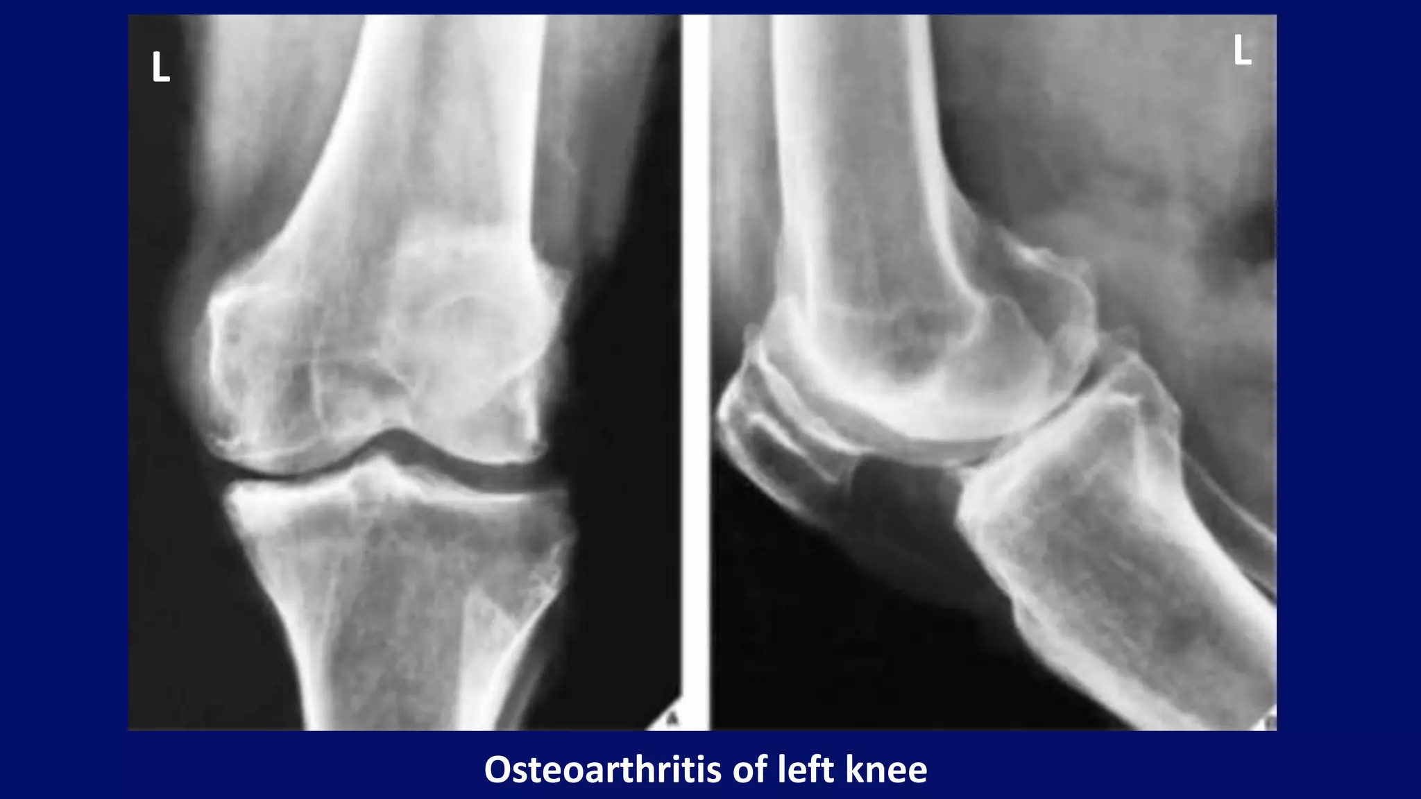 Osteoarthritis of left knee
L L
 