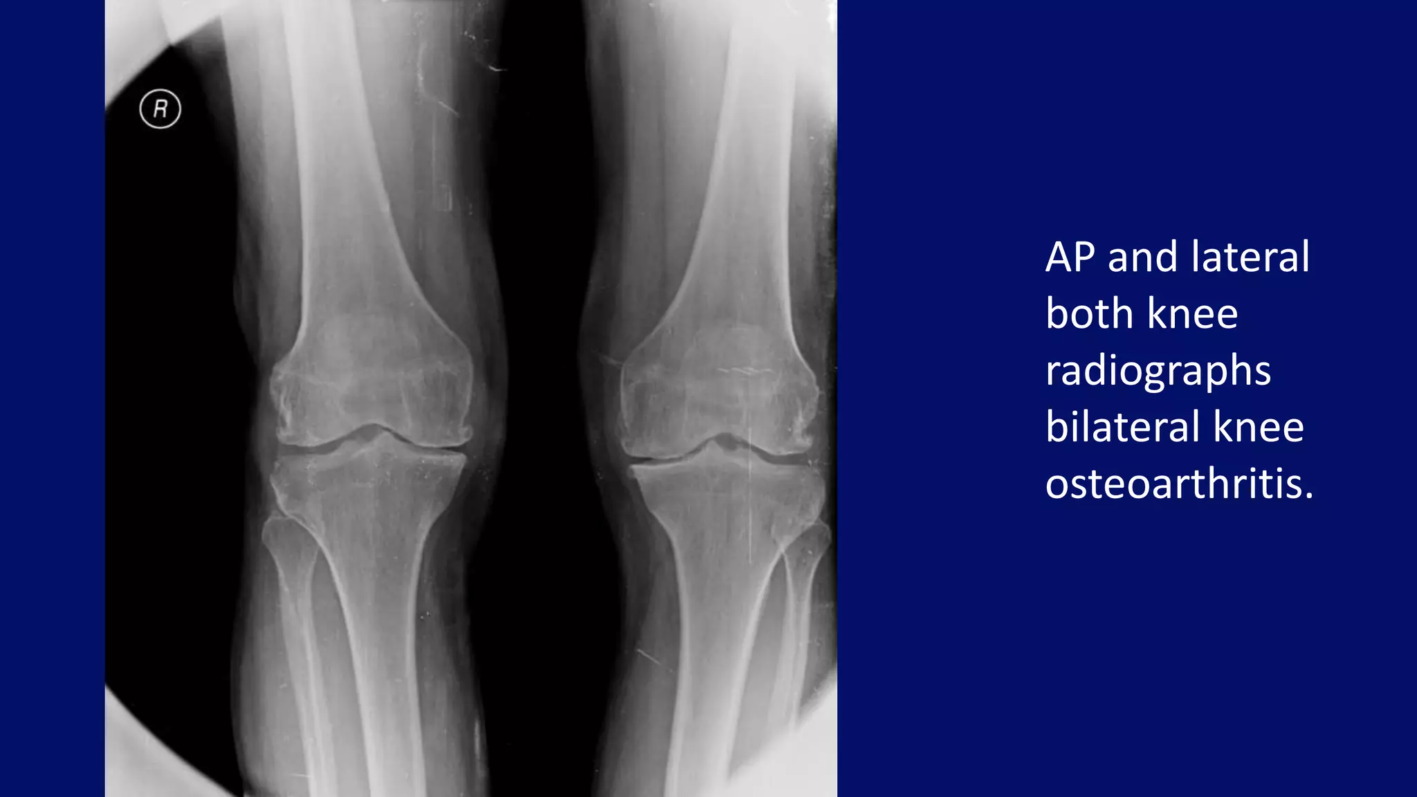 AP and lateral
both knee
radiographs
bilateral knee
osteoarthritis.
 