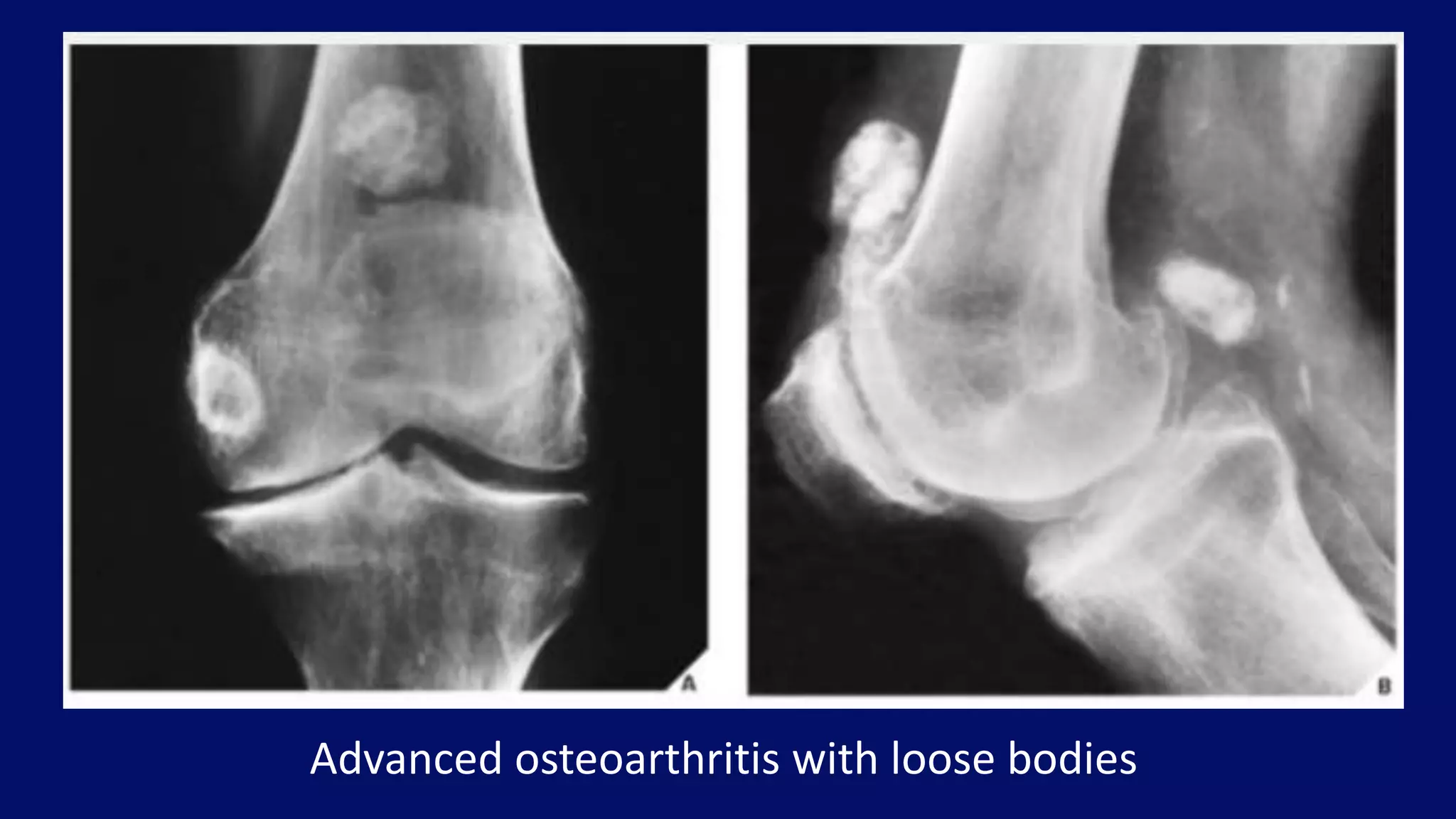 Advanced osteoarthritis with loose bodies
 